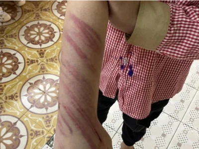 太惨了！越南一小女孩被母亲的男友虐待，全身被打伤