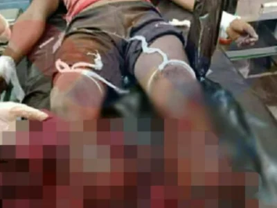 缅甸小镇外出砍柴的24岁男子误踩地雷，右腿膝盖以下被炸断
