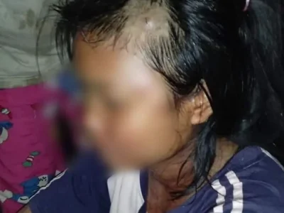 缅北贵概村寨一名女青年前往镇上办“马崩丁”，被炮弹残片伤到大腿